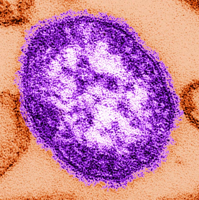 Texas measles outbreak grows to nearly 150 cases as more patients are hospitalized