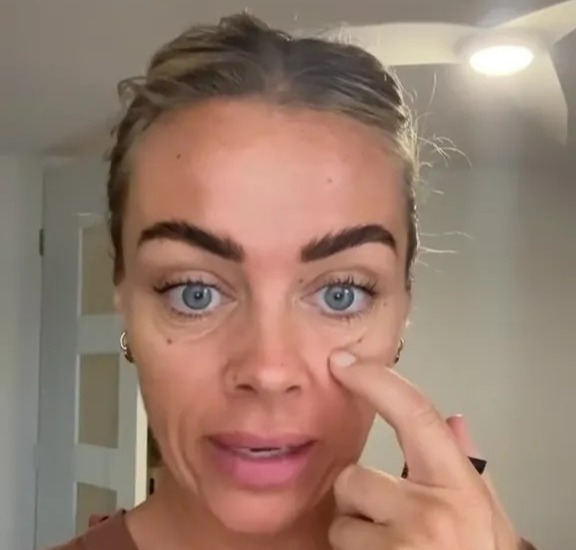 Woman left with terrible eyebags shares eBay buy that’s Botox in a bottle & instantly banishes her w...