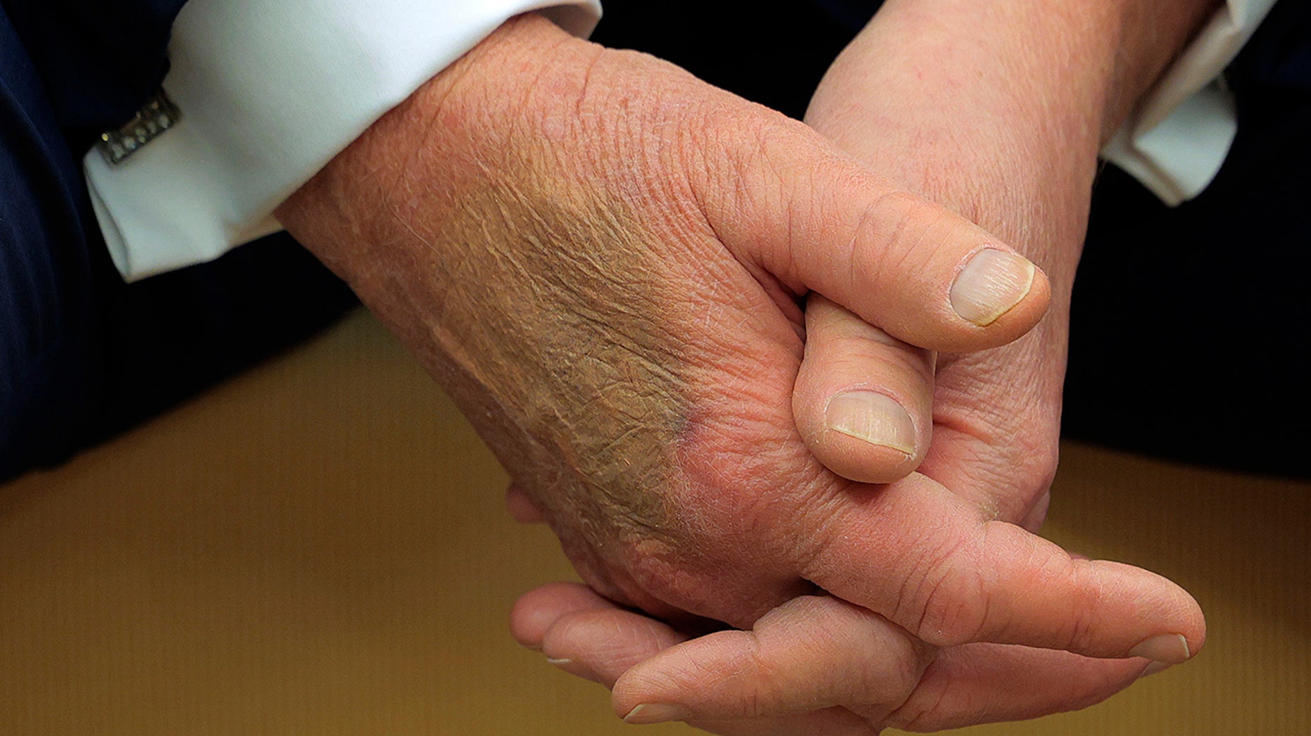 White House explains bruise on Trump's hand seen during Macron meeting